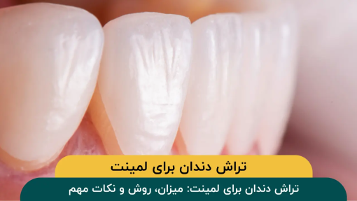 تراش-دندان-برای-لمینت